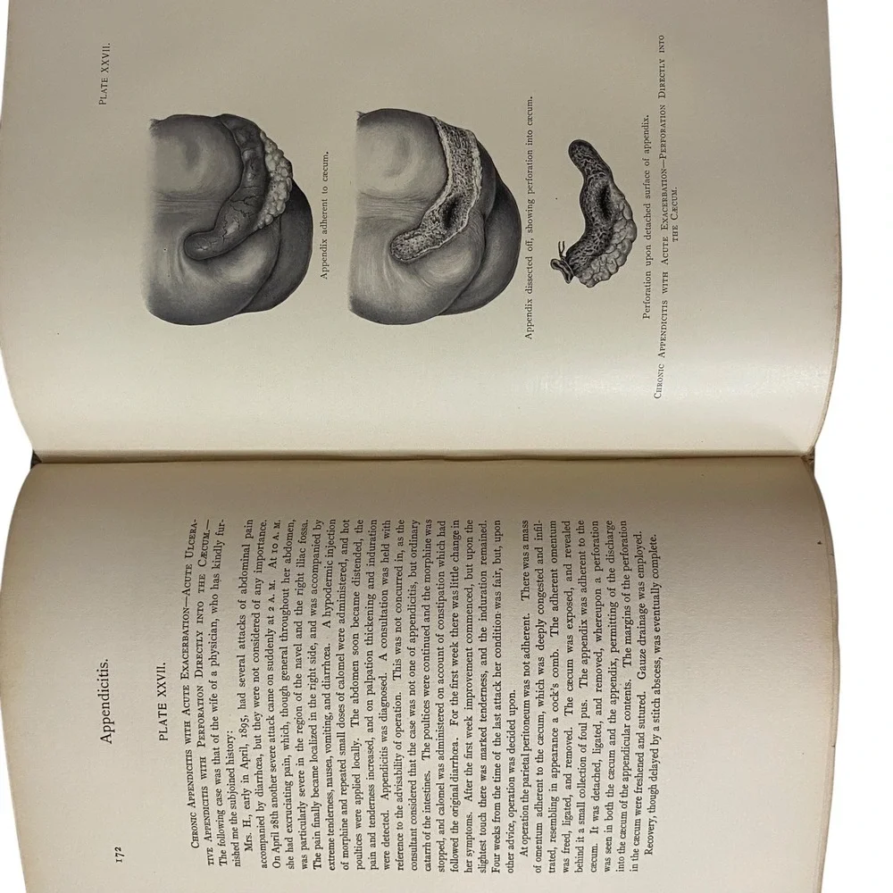 1905 Appendicitis Diagnosis Treatment John‎ B Deaver 3rd Ed Medical History Book